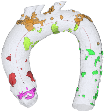 Computational Platform for Non-Invasive Modelling of Aortic Parameters for Clinical Assessment and Stroke Prevention