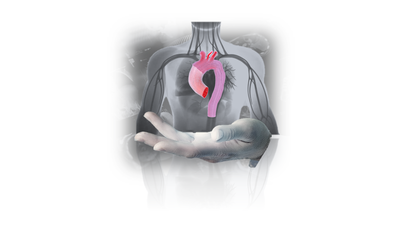 Pre-operative Assistant Based on Data-Driven Approaches for Vascular Grafts Surgery